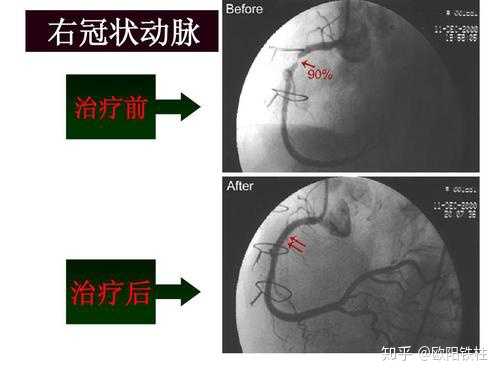 首輪冠脈支架國家集採開標從均價13萬降至中位價格700元對病人與醫生