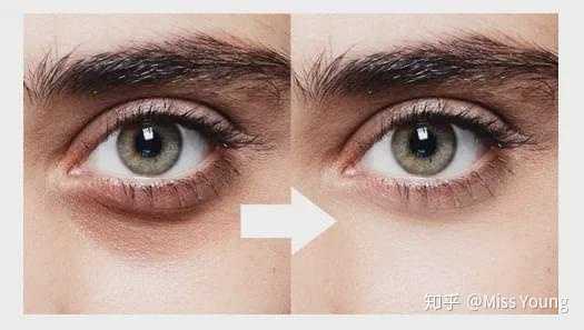 黑眼圈常年不消要怎么办 知乎