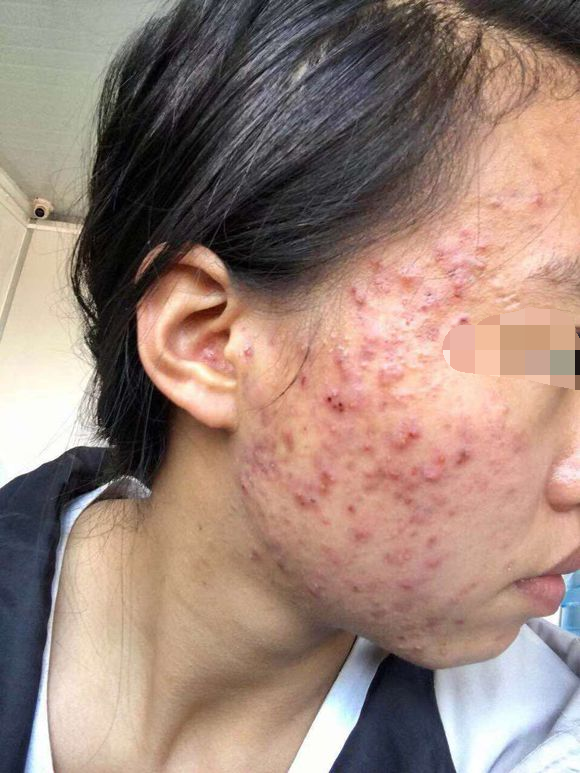 正是青春期的我们,相信大多数同学和我一样或多或少都有爆过痘痘.