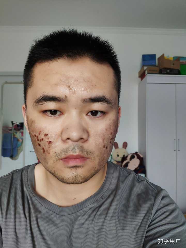 点阵激光去痘坑的效果如何 知乎 点阵激光去痘坑的效果如何 知乎