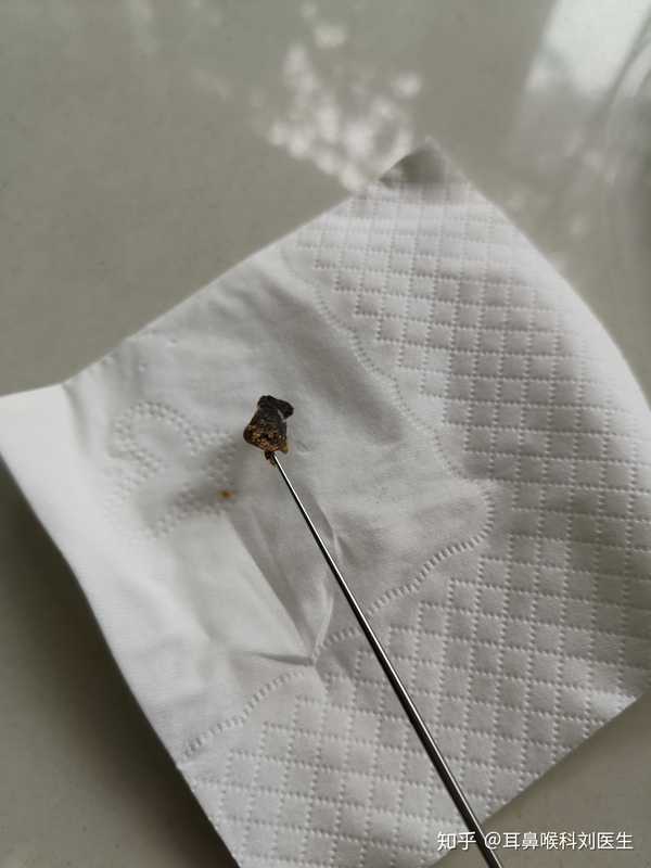 儿童什么时候取耵聍比较合适