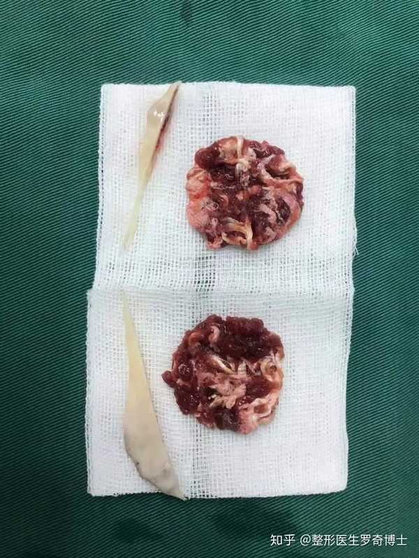 整形医生罗奇博士 的想法: 今天第三台磨骨手术:磨骨瘦脸下颌角削骨…