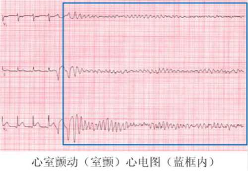 猝死 过劳死有没有先兆 知乎 猝死 过劳死有没有先兆 知乎