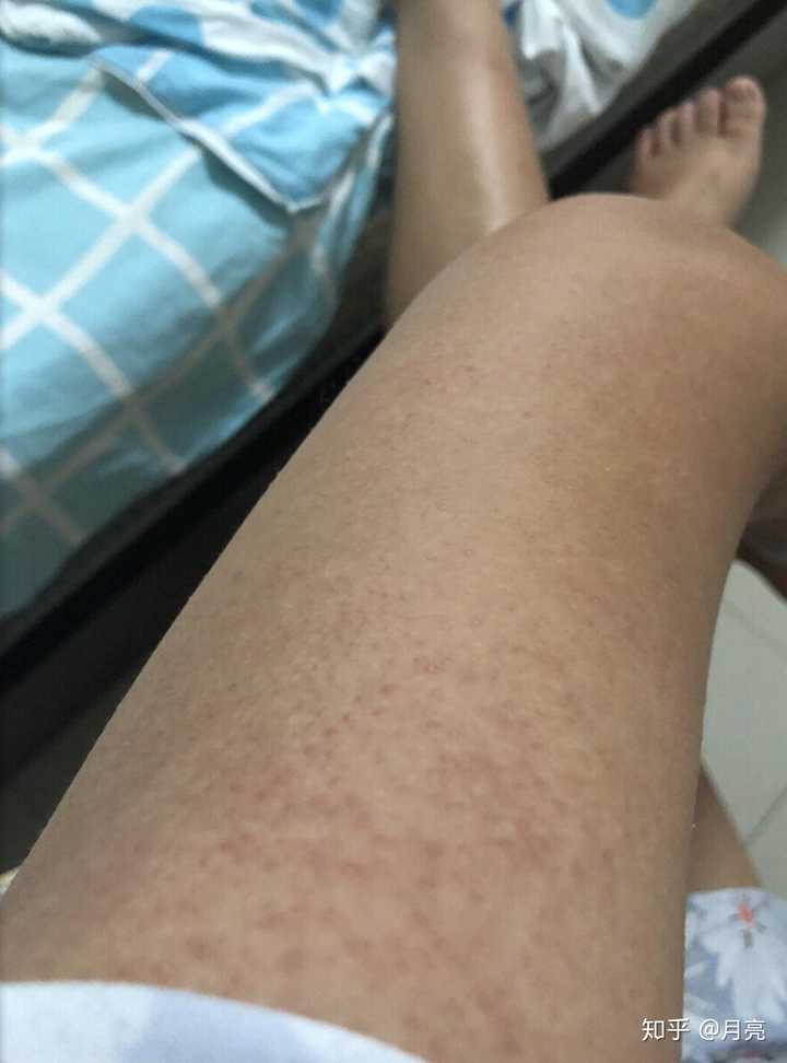 鸡皮肤照片男生穿搭(鸡皮肤照片男生穿搭图)