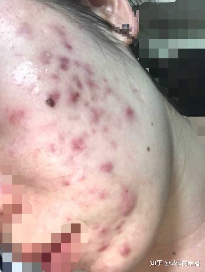 怎样去痘痘 消痘印 知乎 怎样去痘痘 消痘印 知乎