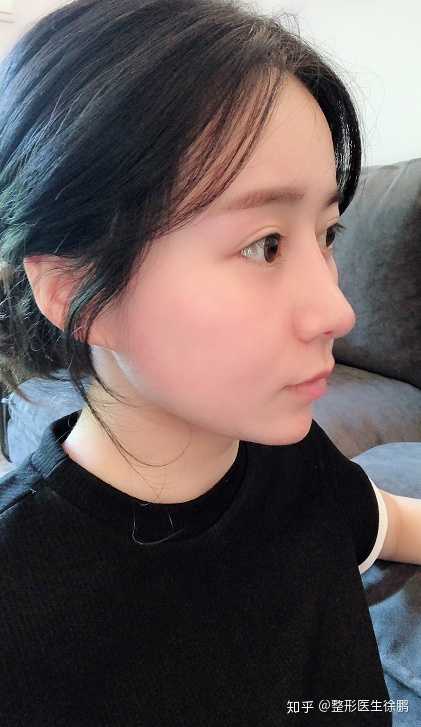 能不能使山根变高一点?