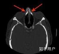 鼻骨骨折消肿后的复位是怎样进行的 如何矫正 知乎 鼻骨骨折消肿后的复位是怎样进行的 如何矫正 知乎