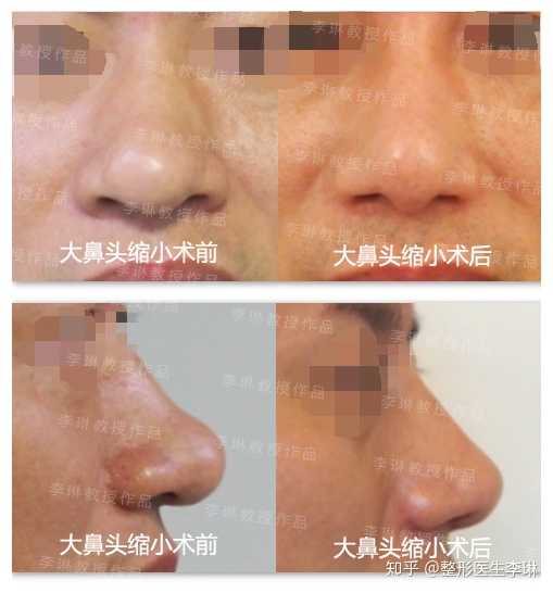 可以参考一下我做大鼻头缩小的手术对比图.