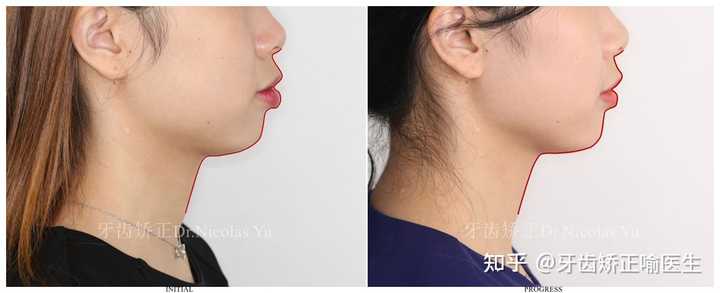整牙成功是什么体验 知乎