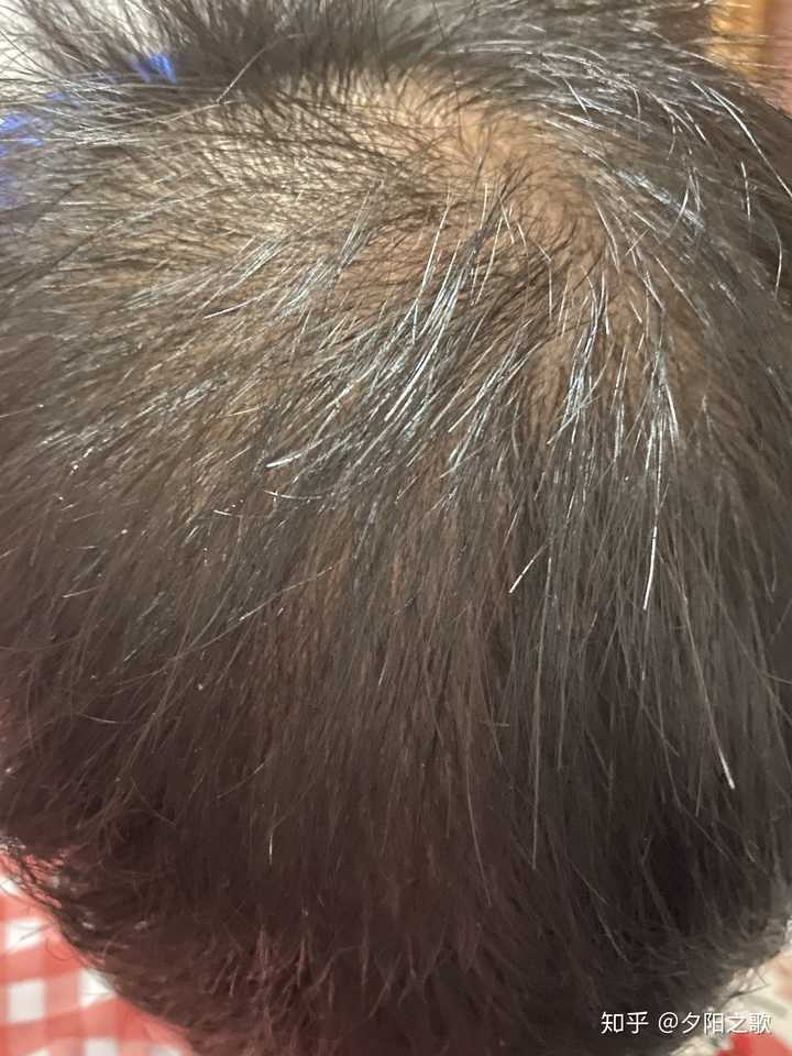 头顶脱发严重本人男22岁求解