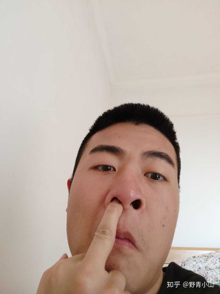 鼻孔挖大了怎么办还能恢复吗