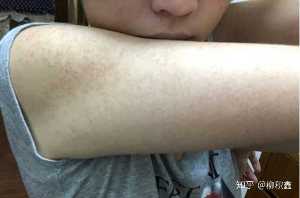 十岁女孩鸡皮肤(孩子十岁了有鸡皮肤怎么治疗)