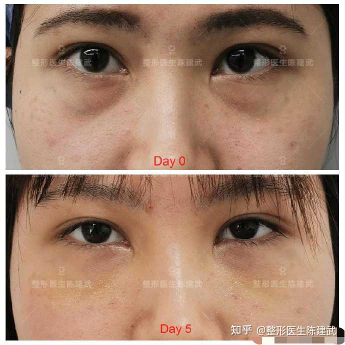 怎样消除下眼袋 如何消除黑眼圈和眼袋 知乎 怎样消除下眼袋 如何消除黑眼圈和眼袋 知乎