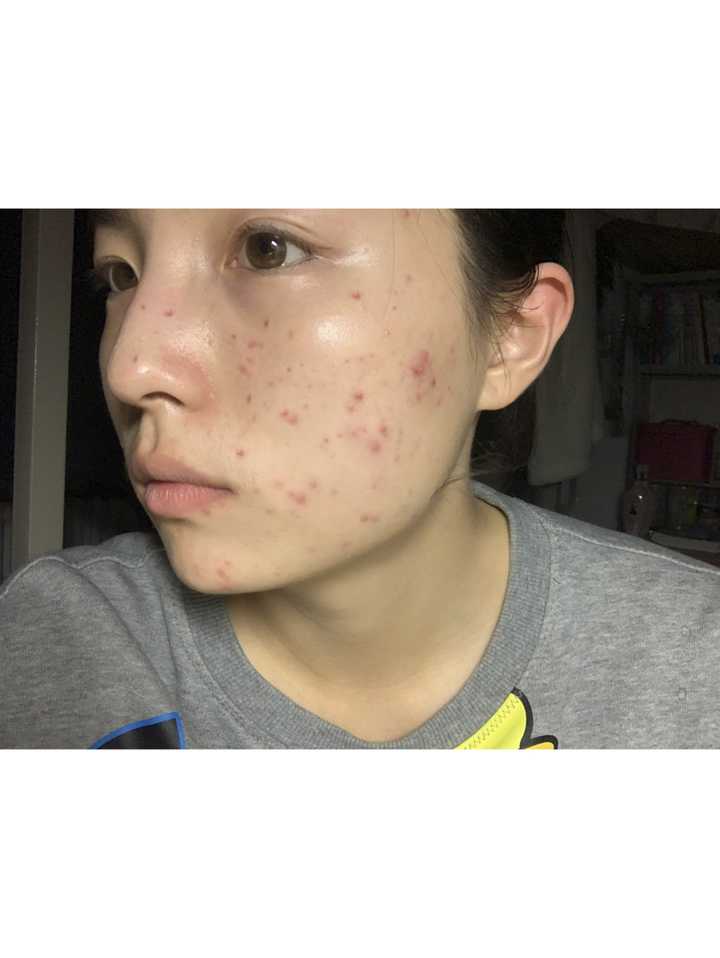 额头上长痘痘是什么原因造成的 怎么才可以消除呢 知乎