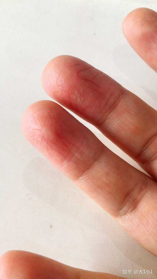 手指尖脱皮与气候季节的相关性是怎么形成的