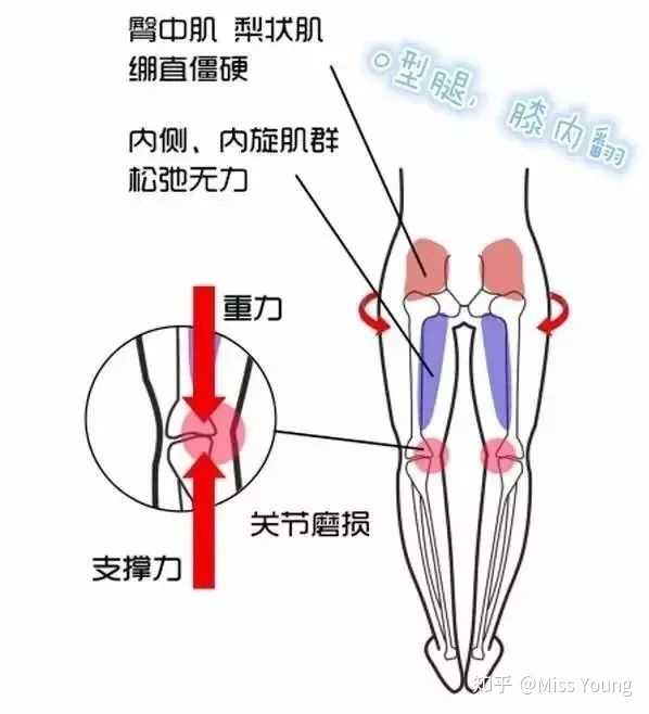 x型腿:大腿内旋 小腿外旋.