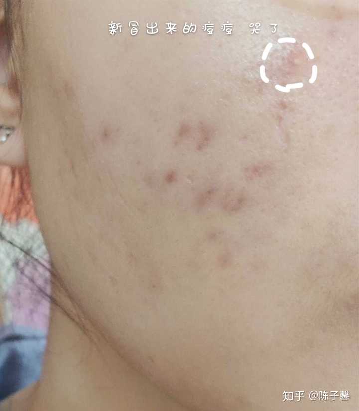 有哪些祛痘印产品曾惊艳过你？
