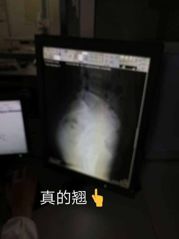 尾骨骨折是一种怎样的体验 知乎