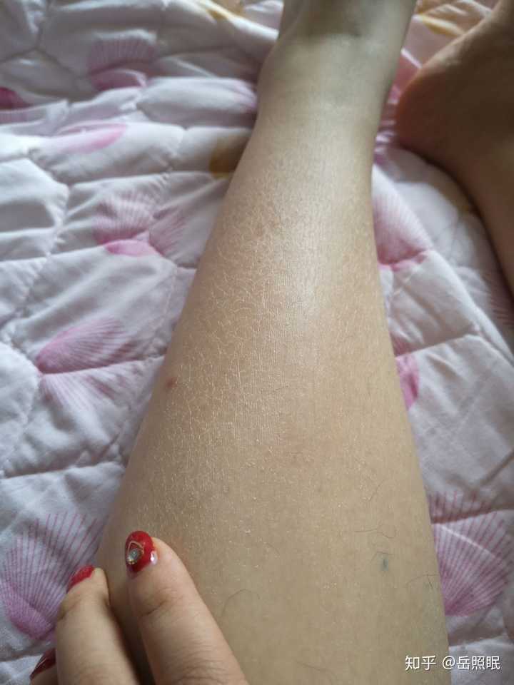 夏天男朋友会嫌弃鸡皮肤吗(男生会讨厌有鸡皮肤的女生吗)