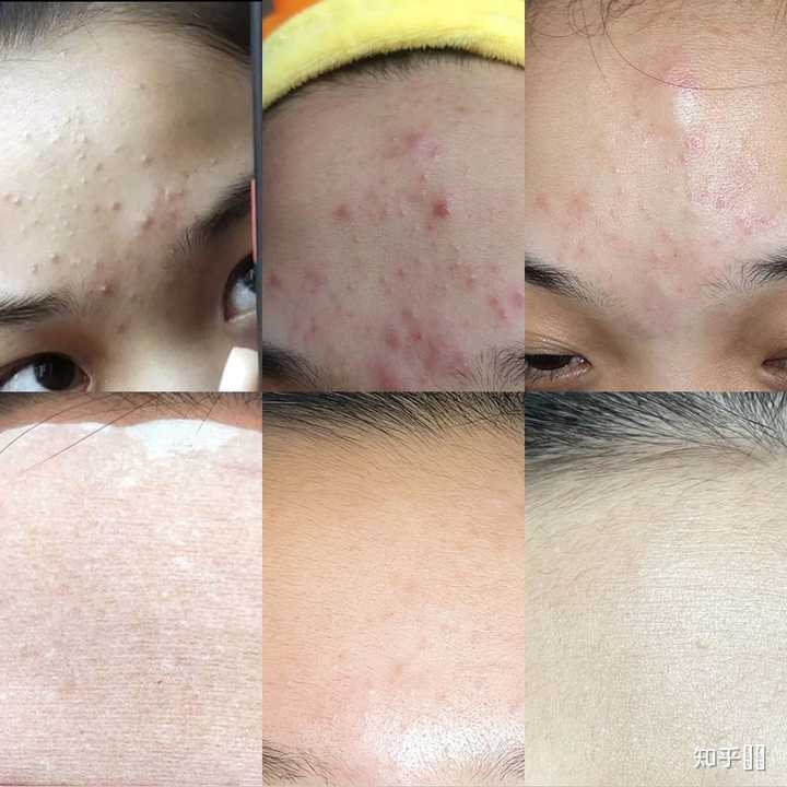 脸上有闭口和黑头要怎么解决? - 知乎