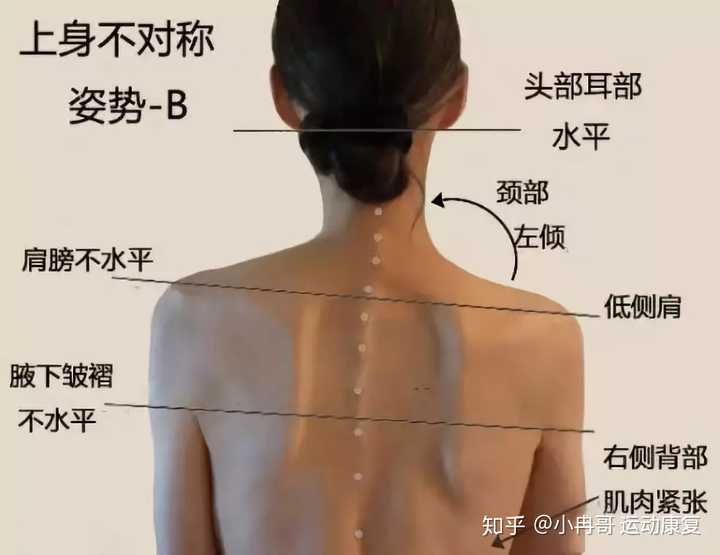 如何解决高低肩的问题 知乎 如何解决高低肩的问题 知乎