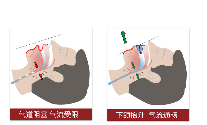 止鼾器是否真的管用 那一种类型的止鼾器管用呢 知乎