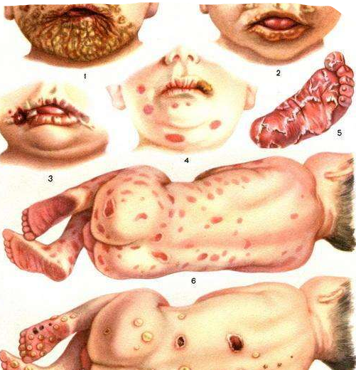婴儿梅毒有什么症状图片