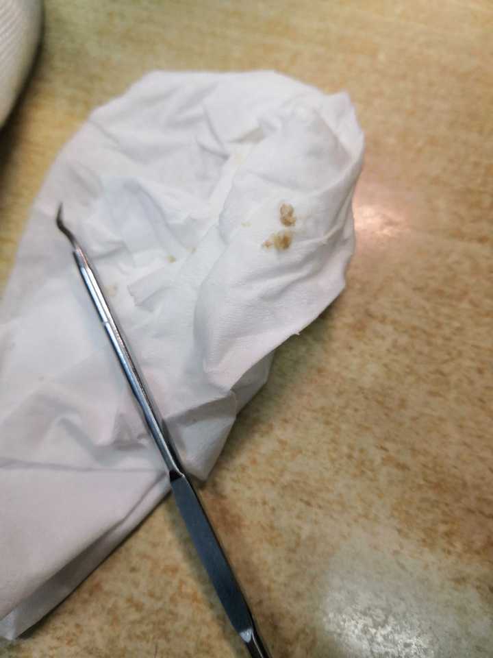 史上最大的黑头有多大?