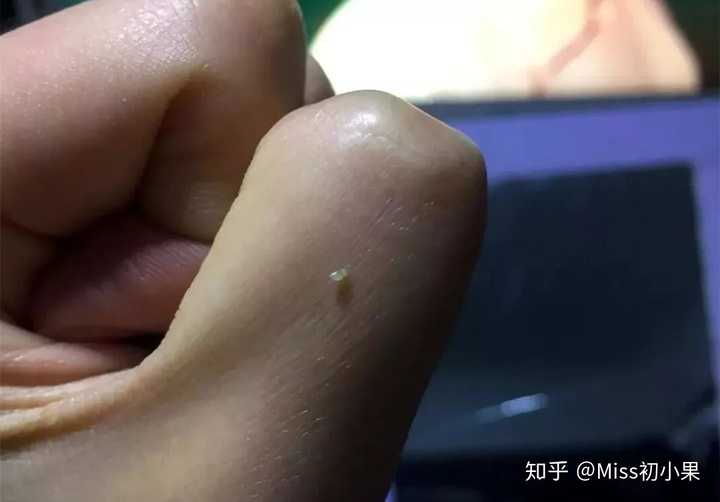 怎么消除眼睛上的脂肪粒 知乎