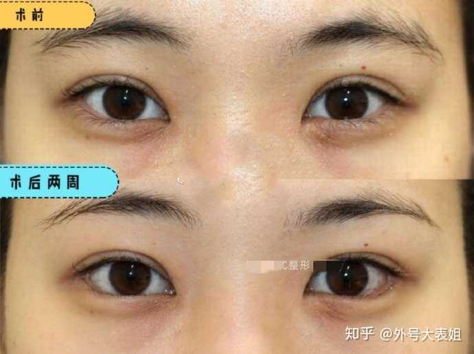 开外眼角有什么不好吗?