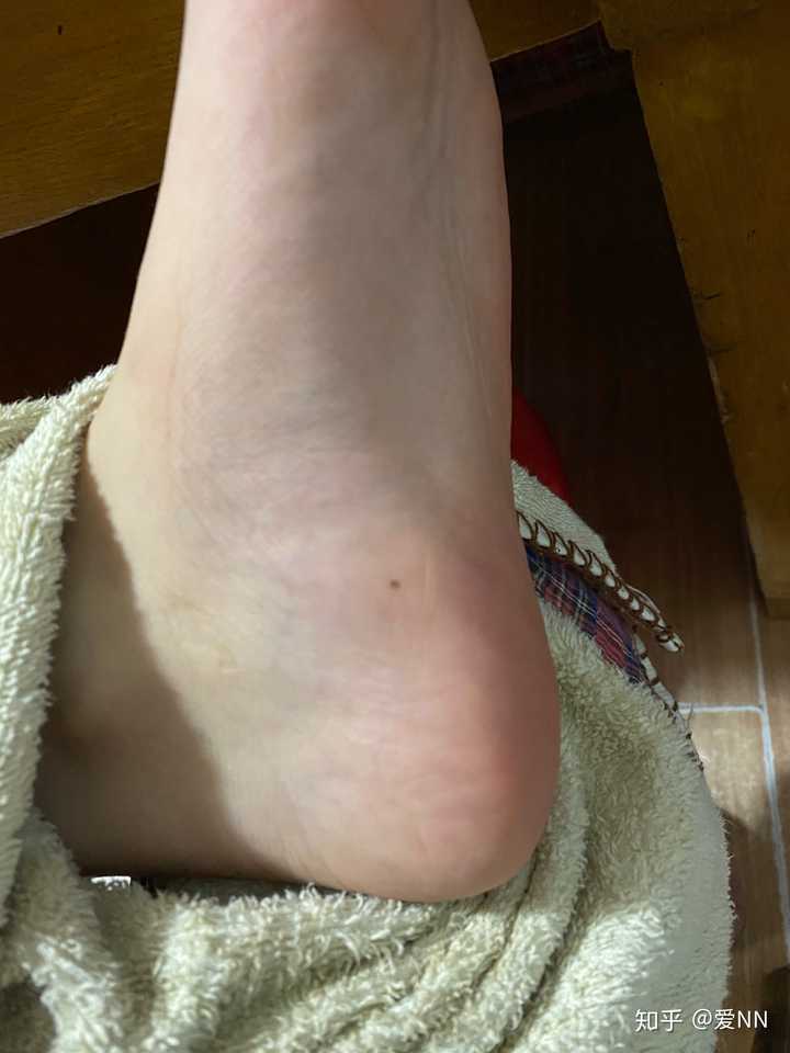 脚底旁边有痣需要去掉吗