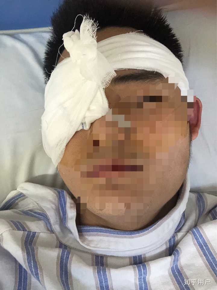 单眼失明是种怎样的体验?