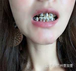 戴牙套一般要多久 知乎