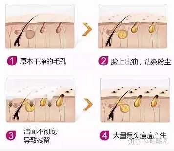 维a酸软膏真的能去黑头吗 知乎