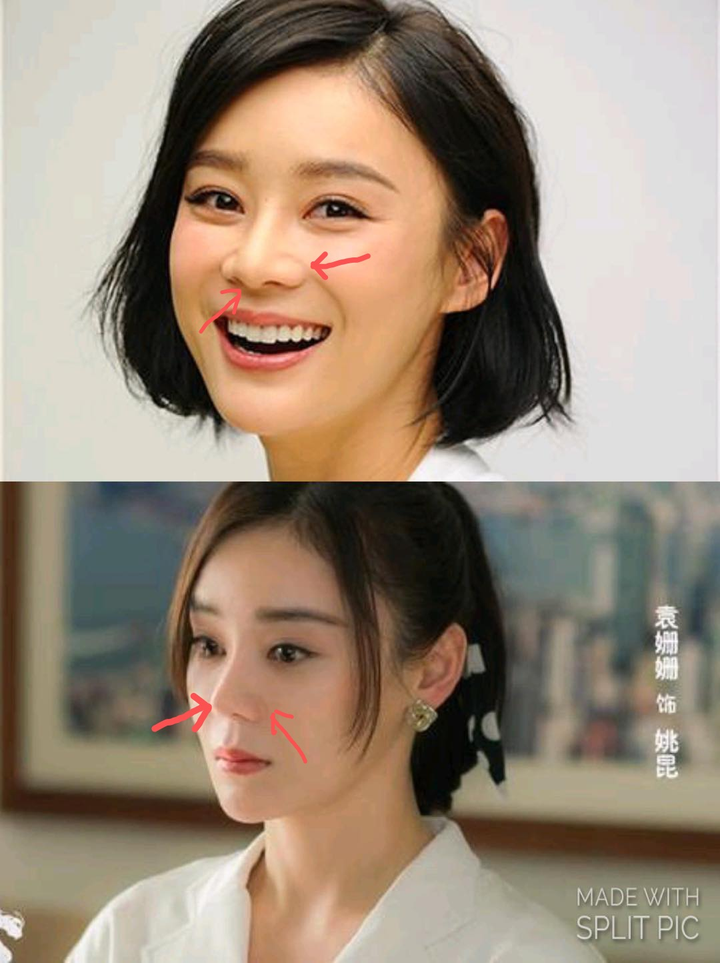 想做鼻头鼻翼缩小手术,应该注意哪些?