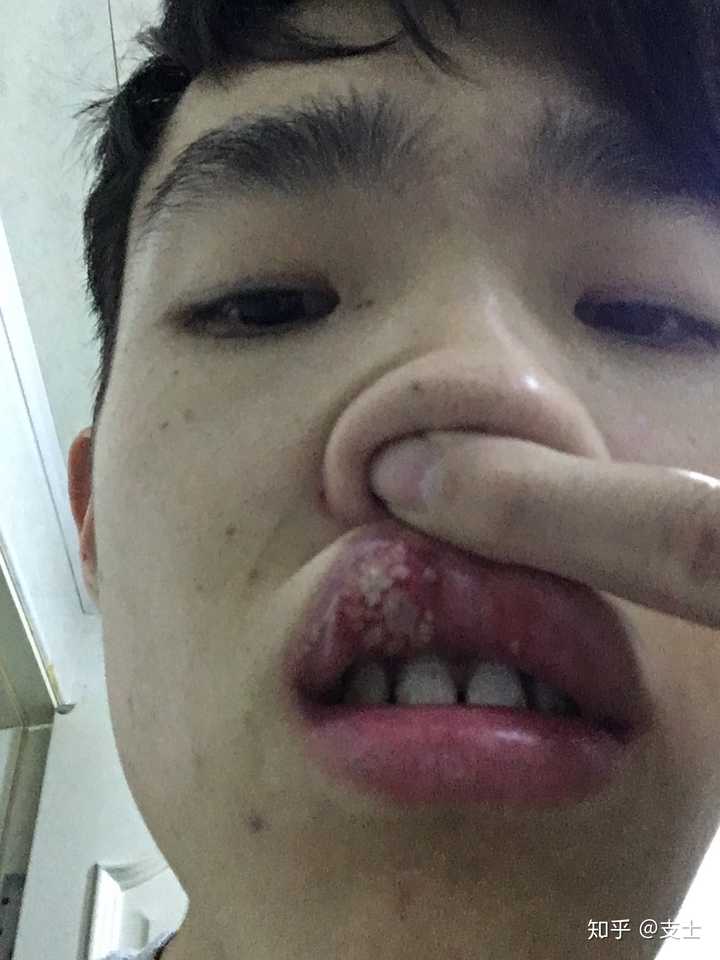 注意审题大家口腔溃疡最严重时能长多少多大