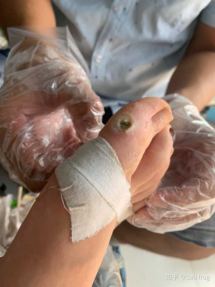 鸡眼怎么彻底挖出