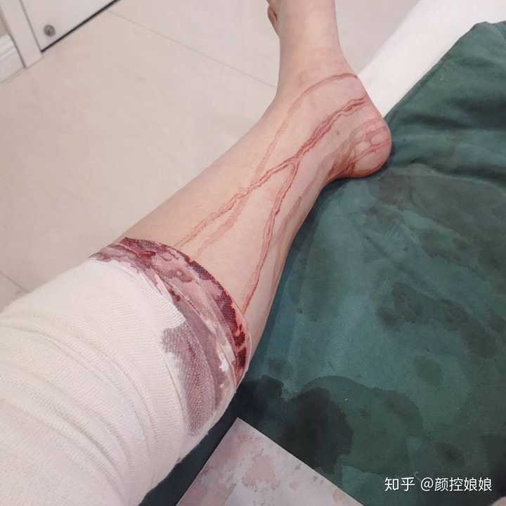 大腿吸脂是一种怎样的经历?