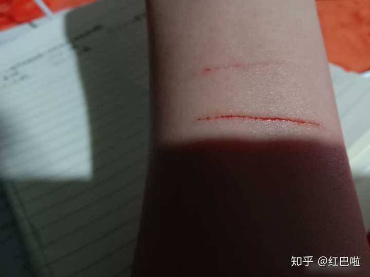 第三次自残很轻