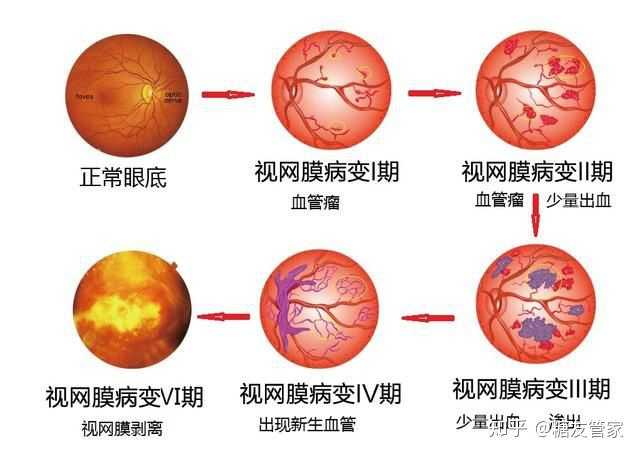 糖尿病视网膜病