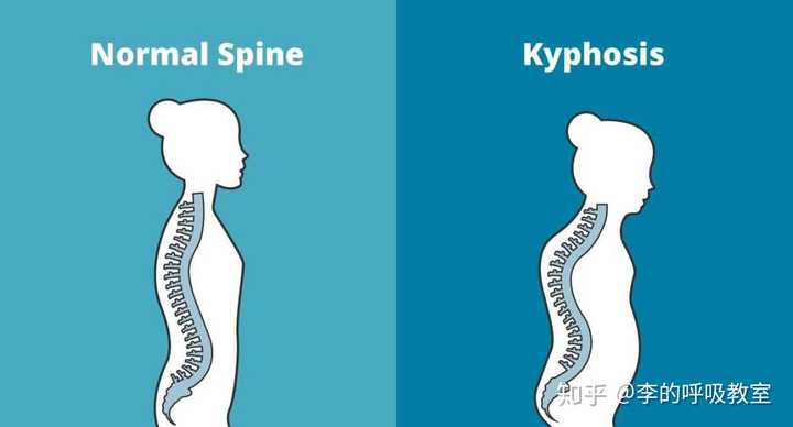 脊柱侧弯和驼背区别图图片