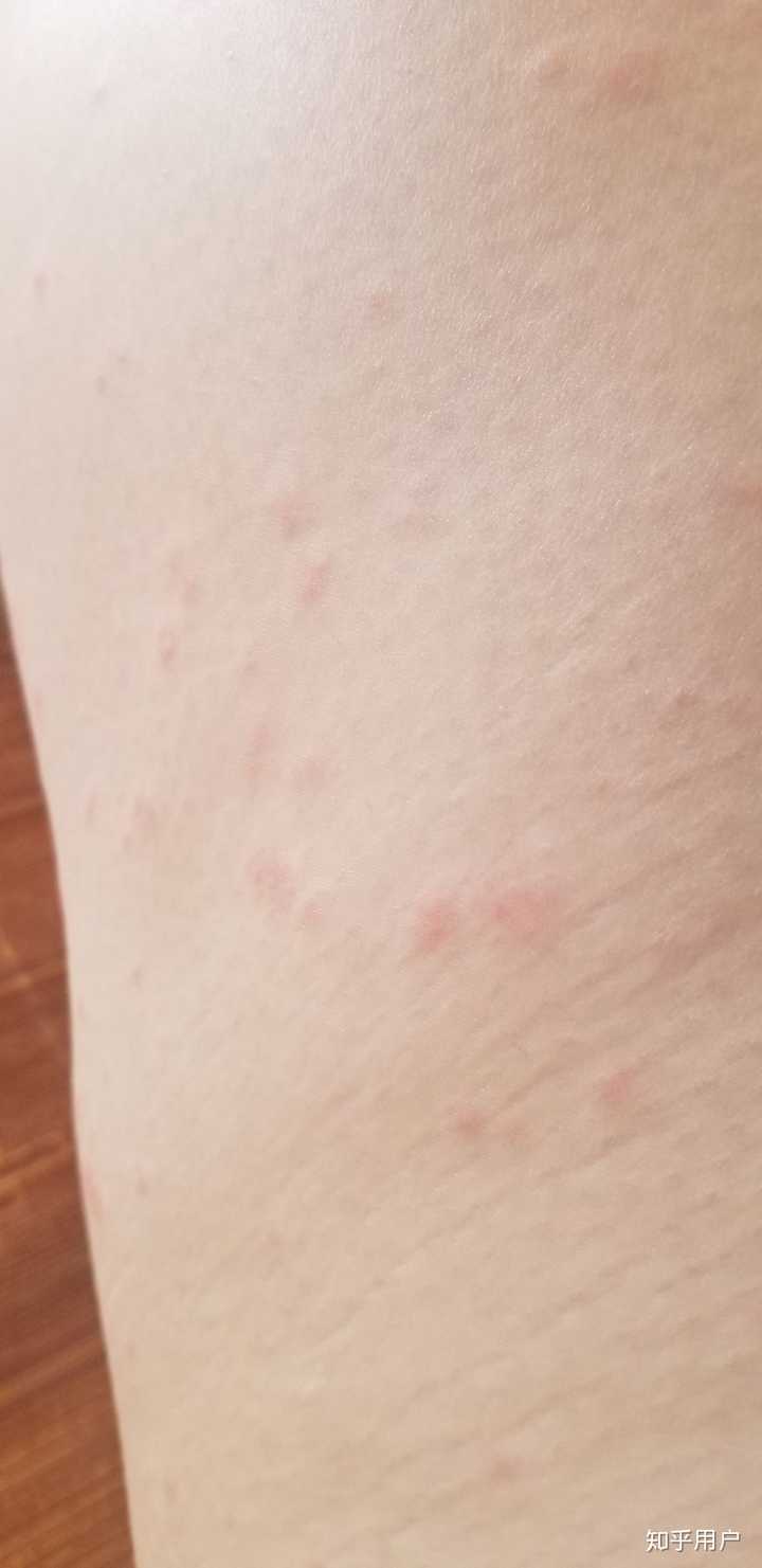 孕妇湿疹怎么办 知乎 孕妇湿疹怎么办 知乎