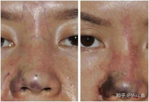 而且玻尿酸注射多次会鼻背变宽,如上图所示,而且面部血管比较多,医生