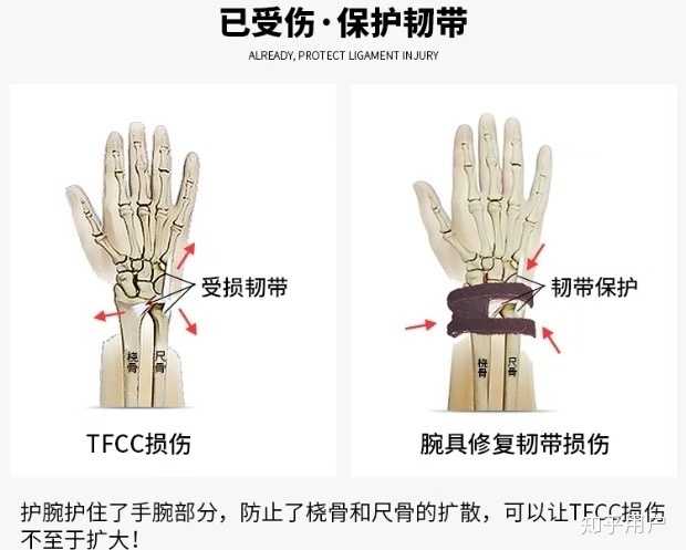 三角纤维软骨 Tfcc 损伤 该如何治疗和康复呢 知乎