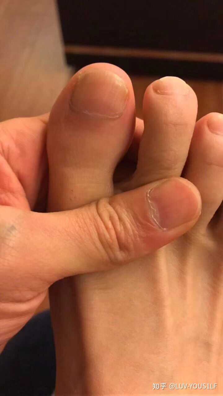 灰指甲疼吗 知乎 灰指甲疼吗 知乎