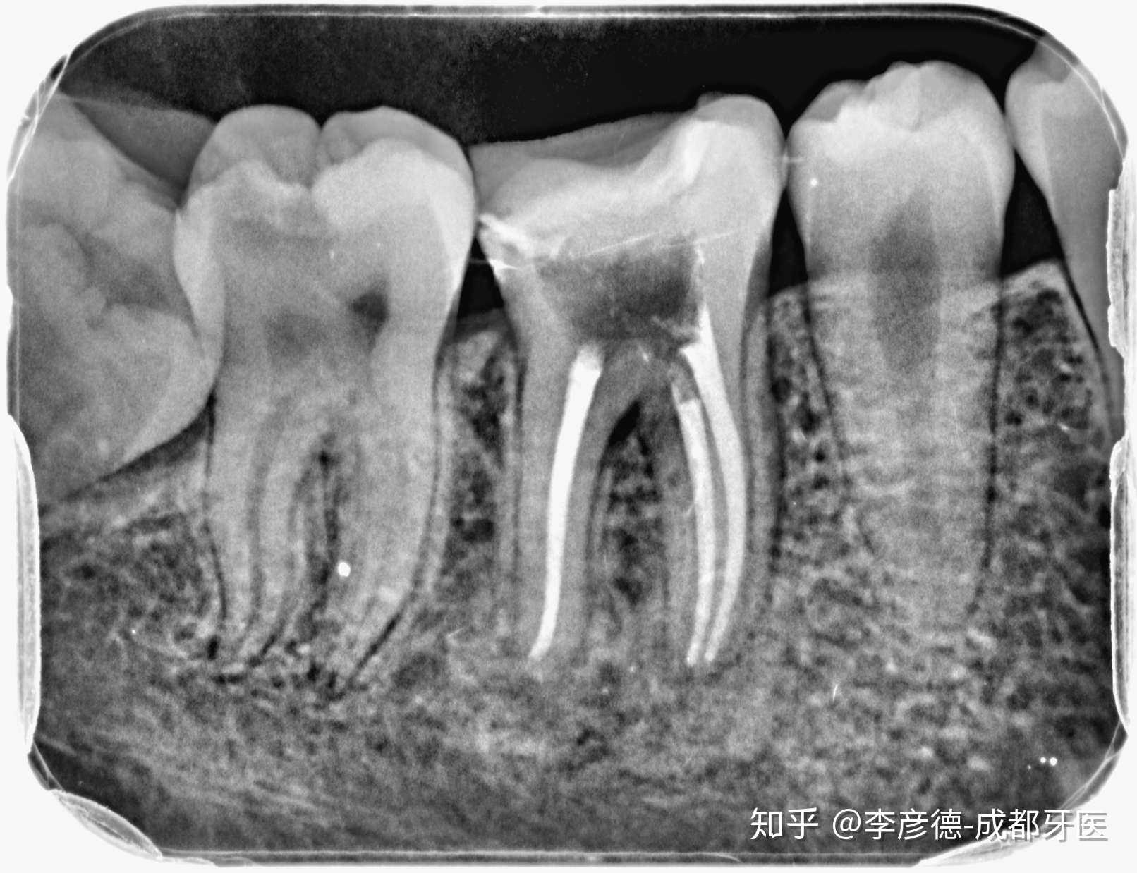 根管治疗照片图片