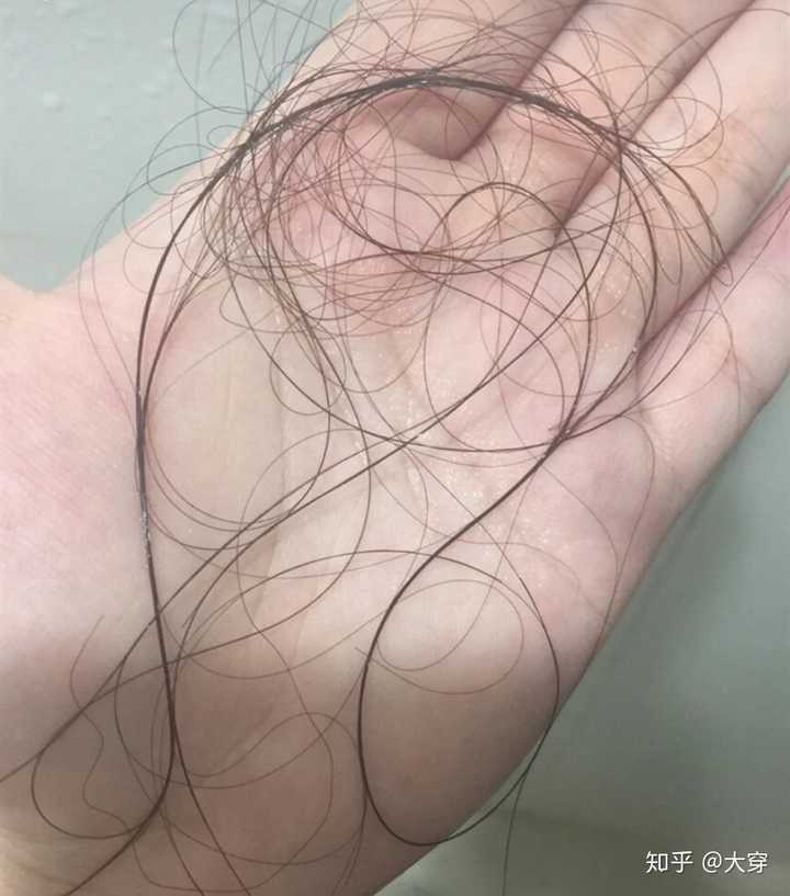 有什么治疗脱发亲测有效的方法?