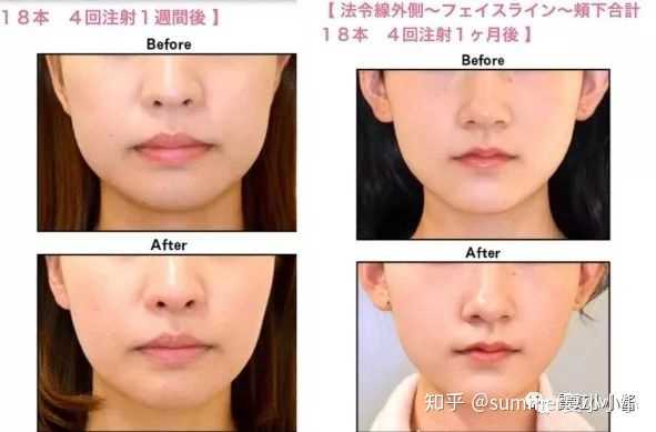 可以请学医或者医美的人谈谈溶脂针的效果或危害吗 打过的人献身说法最好了 知乎 可以请学医或者医美的人谈谈溶脂针的效果或危害吗 打过的人献身说法最好了 知乎