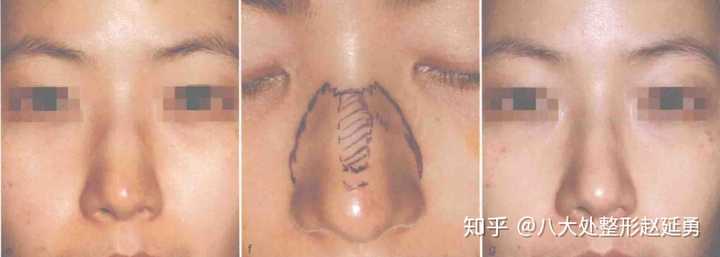 有鼻骨宽的做鼻骨内推手术的吗 知乎 有鼻骨宽的做鼻骨内推手术的吗 知乎