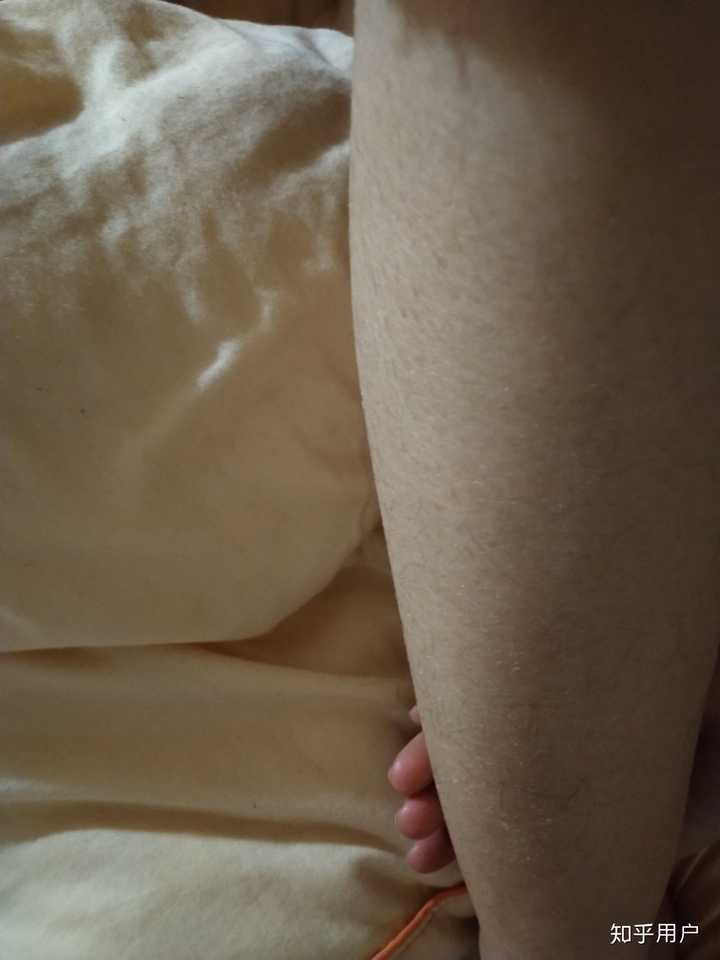 鱼鳞病还有未来吗 知乎